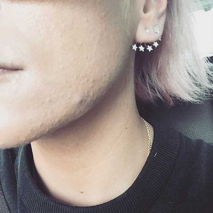 Lily Allen experiences the same beauty issues as anyone else and questioned why she was still experiencing acne at 30 years old, calling it a "#1stworldproblem"